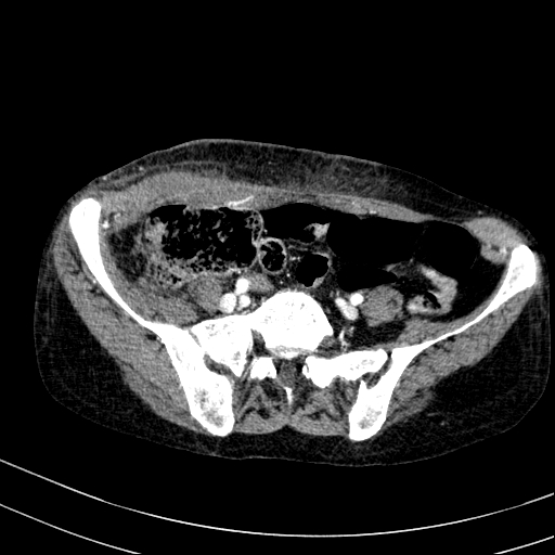Abdominal wall hematoma with active bleeding (Radiopaedia 83915-99117 Axial renal cortical phase 93).jpg