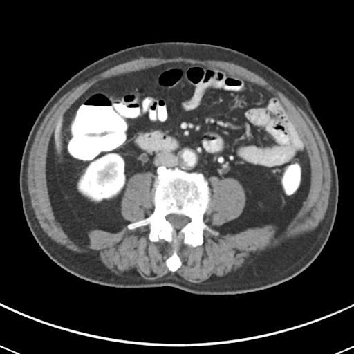 Abdominal wall metastasis from colorectal carcinoma (Radiopaedia 31016-31717 Axial C+ portal venous phase 41).jpg