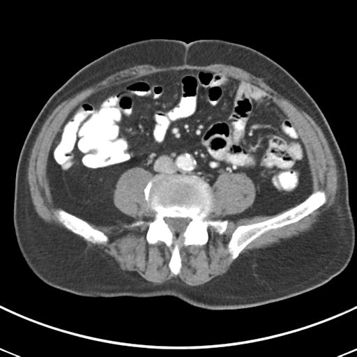 File:Abdominal wall metastasis from colorectal carcinoma (Radiopaedia 31016-31717 Axial C+ portal venous phase 46).jpg