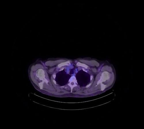 Abdominal wall metastasis from colorectal carcinoma (Radiopaedia 31016-31719 Axial 124).jpg
