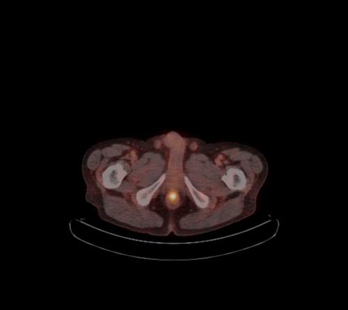 Abdominal wall metastasis from colorectal carcinoma (Radiopaedia 31016-31719 C 15).jpg