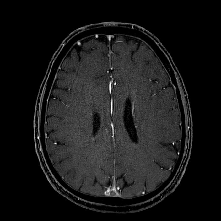Accessory middle cerebral artery (Radiopaedia 73114-83828 Axial MRA 143).jpg