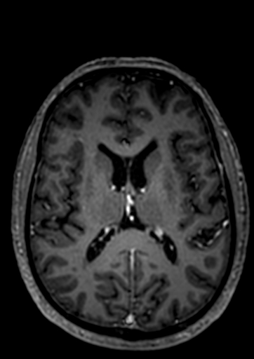 Accessory middle cerebral artery (Radiopaedia 73114-83828 Axial T1 C+ 10).jpg