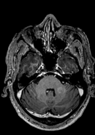 Accessory middle cerebral artery (Radiopaedia 73114-83828 Axial T1 C+ 121).jpg