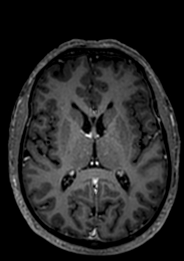 Accessory middle cerebral artery (Radiopaedia 73114-83828 Axial T1 C+ 20).jpg