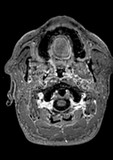 Accessory middle cerebral artery (Radiopaedia 73114-83828 Axial T1 C+ 209).jpg