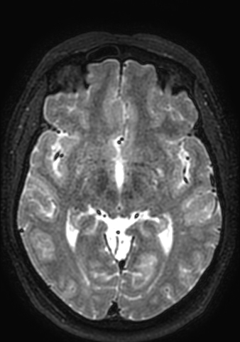 Accessory middle cerebral artery (Radiopaedia 73114-83828 Axial T2 92).jpg
