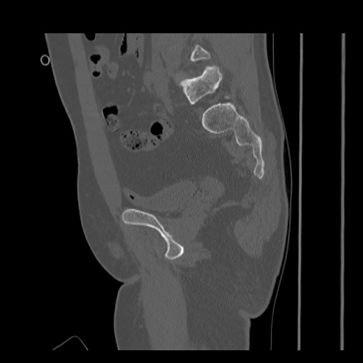 File:Acetabular and ilial fractures (Radiopaedia 59084-66378 Sagittal bone window 43).jpg