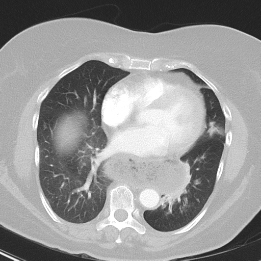 File:Achalasia (Radiopaedia 47147-51685 Axial lung window 31).png