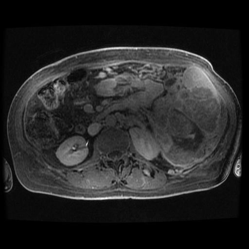 Acinar cell carcinoma of the pancreas (Radiopaedia 75442-86668 Axial late phase (~30 mins) 36).jpg