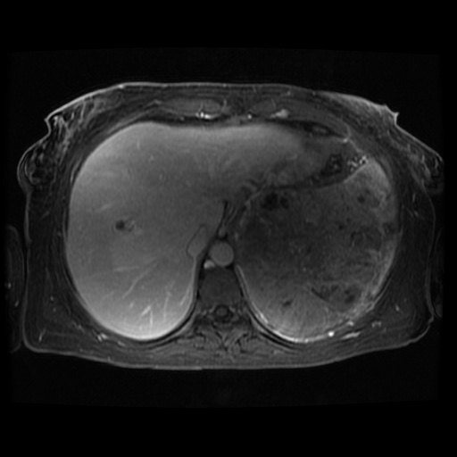 Acinar cell carcinoma of the pancreas (Radiopaedia 75442-86668 D 113).jpg