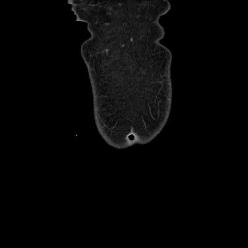 Acinar cell carcinoma of the pancreas (Radiopaedia 75442-86669 Coronal C+ portal venous phase 7).jpg