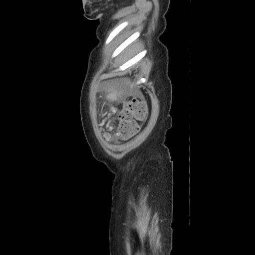 Acinar cell carcinoma of the pancreas (Radiopaedia 75442-86669 Sagittal C+ portal venous phase 178).jpg