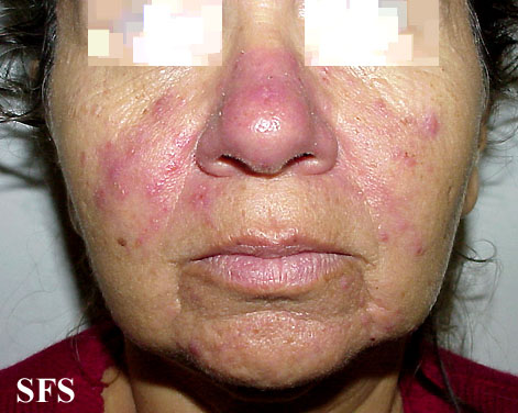 File:Acne Rosacea (Dermatology Atlas 14).jpg