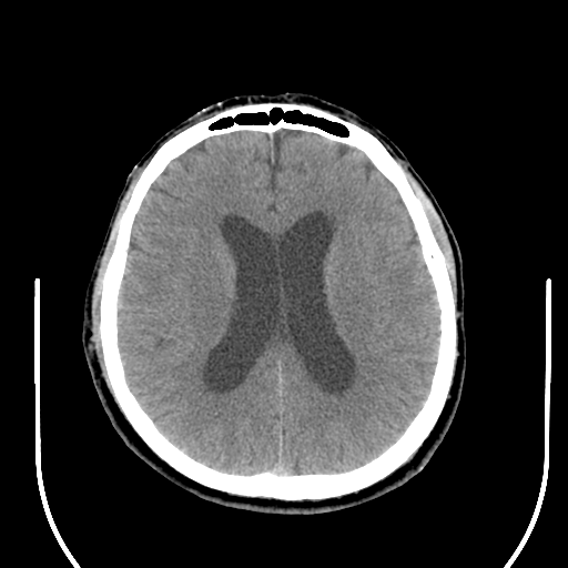 File:Acoustic schwannoma (Radiopaedia 39170-41388 Axial non-contrast 30).png