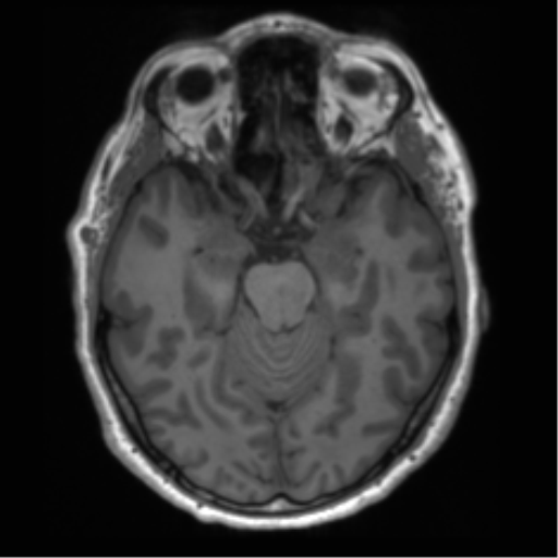 File:Acoustic schwannoma (Radiopaedia 50846-56358 Axial T1 41).png