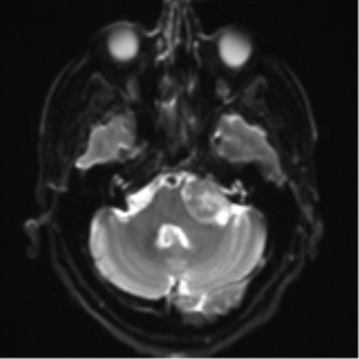 Acoustic schwannoma (Radiopaedia 55729-62281 E 5).png