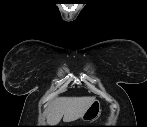 Acromioclavicular joint cyst (Radiopaedia 58455-65610 Coronal C+ arterial phase 25).jpg