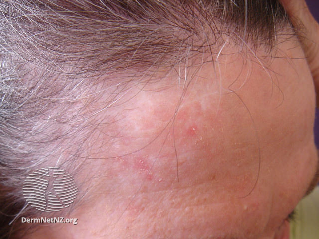 File:Actinic Keratoses treated with imiquimod (DermNet NZ lesions-ak-imiquimod-3729).jpg