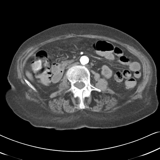 File:Active bleeding from duodenal ulcer with embolization (Radiopaedia 34216-35481 Axial C+ arterial phase 29).png