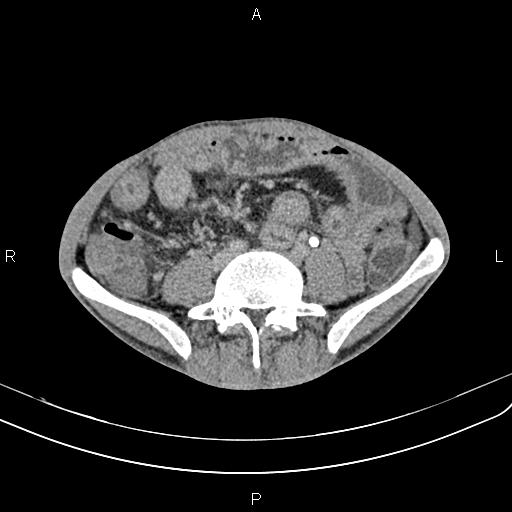 Active crohn disease (Radiopaedia 87133-103397 Axial C+ delayed 42).jpg