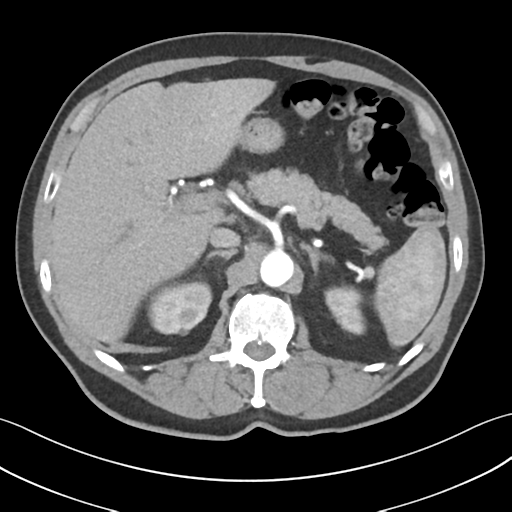File:Active diverticular hemorrhage (Radiopaedia 39415-41725 Axial C+ arterial phase 17).png