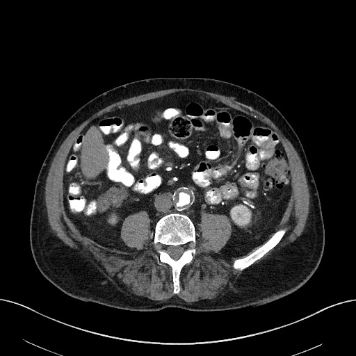File:Active lower gastrointestinal bleeding - diverticular (Radiopaedia 61203-69106 Axial C+ arterial phase 2).jpg