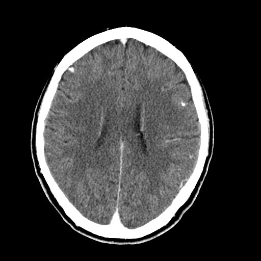 File:Active neurocysticercosis before and after therapy (Radiopaedia 71710-82099 Axial C+ delayed 37).jpg