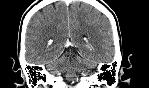 File:Active neurocysticercosis before and after therapy (Radiopaedia 71710-82099 Coronal 16).jpg
