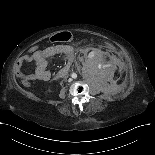 File:Active renal extravasation with large subcapsular and retroperitoneal hemorrhage (Radiopaedia 60975-68796 Axial 235).jpg