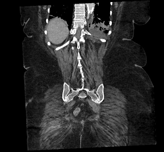 File:Active renal extravasation with large subcapsular and retroperitoneal hemorrhage (Radiopaedia 60975-68796 Coronal C+ portal venous phase 125).jpg