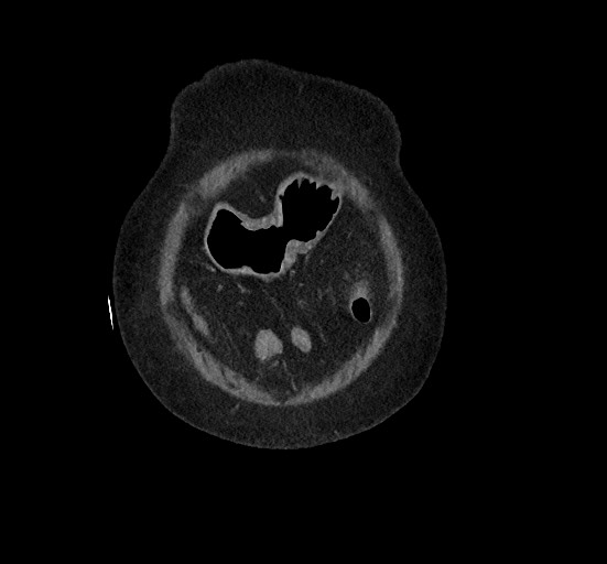 Active renal extravasation with large subcapsular and retroperitoneal hemorrhage (Radiopaedia 60975-68796 Coronal C+ portal venous phase 23).jpg