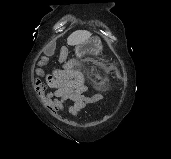 Active renal extravasation with large subcapsular and retroperitoneal hemorrhage (Radiopaedia 60975-68796 Coronal C+ portal venous phase 36).jpg
