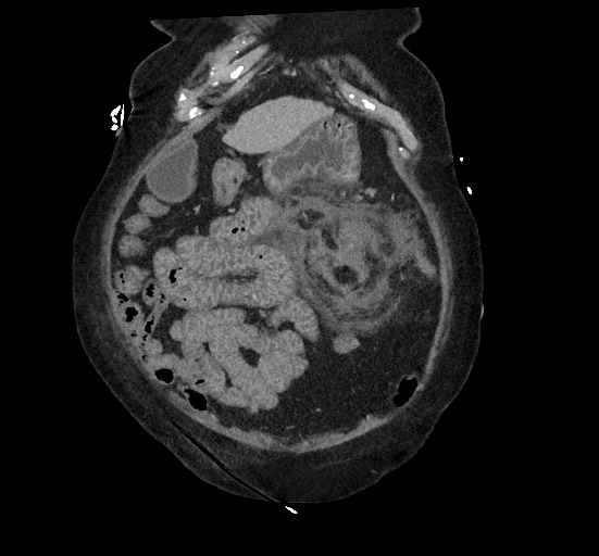Active renal extravasation with large subcapsular and retroperitoneal hemorrhage (Radiopaedia 60975-68796 Coronal C+ portal venous phase 39).jpg