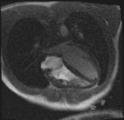 Active right ventricular cardiac sarcoidosis (Radiopaedia 55596-62100 Axial Dynamic perfusion scan MOCO 52).jpg