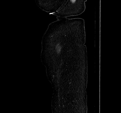 Acute appendicitis, heterotaxy syndrome (Radiopaedia 66884-76202 Sagittal C+ portal venous phase 126).jpg