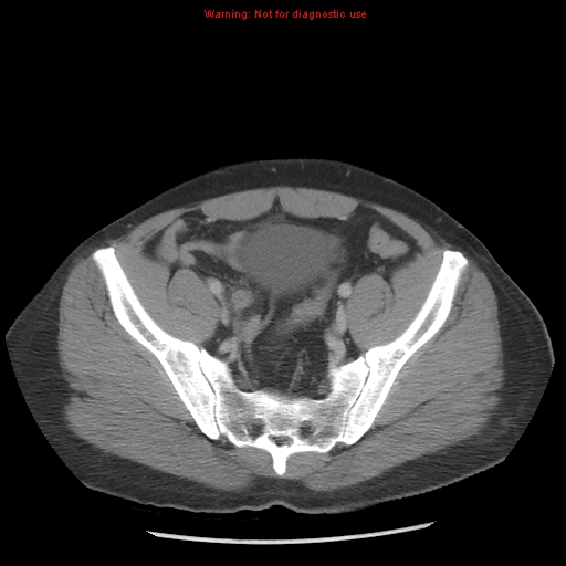 File:Acute appendicitis (Radiopaedia 10498-10973 Axial C+ portal venous phase 39).jpg