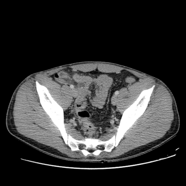 Acute appendicitis (Radiopaedia 27049-27227 Axial C+ portal venous phase 62).jpg