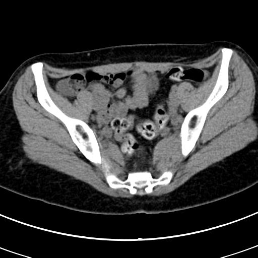 Acute appendicitis (Radiopaedia 30261-30888 Axial non-contrast 82).jpg
