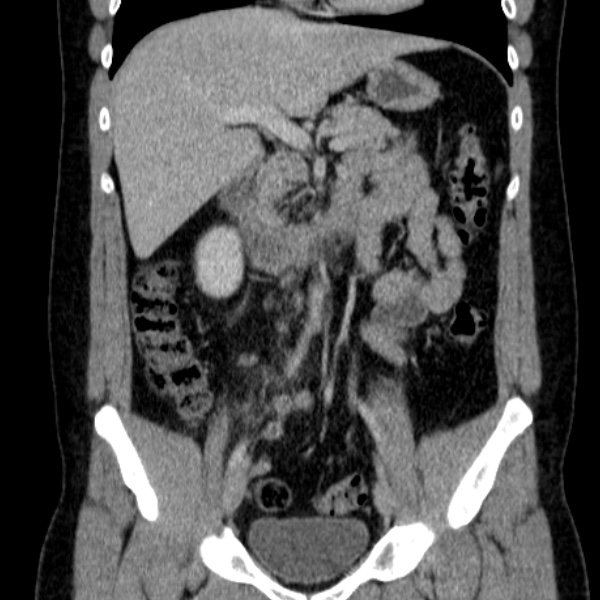 Acute appendicitis (Radiopaedia 38255-40270 Coronal C+ portal venous phase 41).jpg
