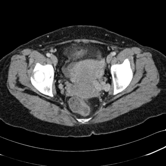 Acute appendicitis (Radiopaedia 48792-53822 Axial C+ portal venous phase 107).jpg