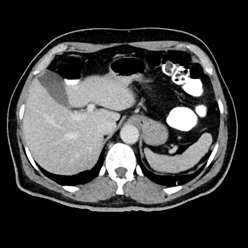 Acute appendicitis (Radiopaedia 77016-88960 Axial C+ portal venous phase 33).jpg