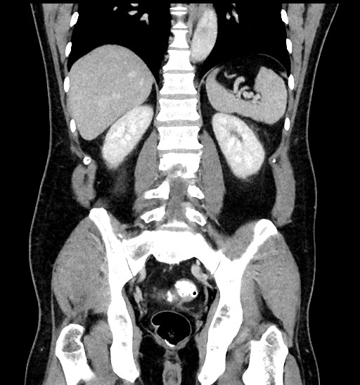 Acute appendicitis (Radiopaedia 77016-88960 Coronal C+ portal venous phase 68).jpg