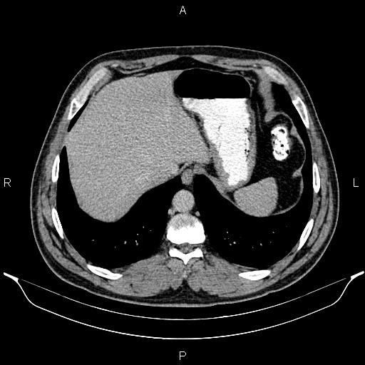 Acute appendicitis (Radiopaedia 84780-100240 Axial C+ portal venous phase 16).jpg