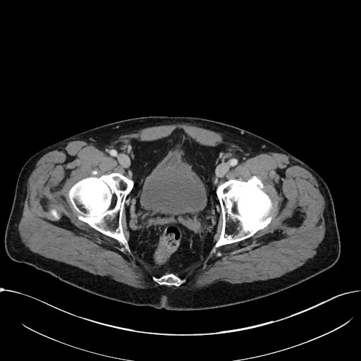 Acute appendicitis - large appendicoliths (Radiopaedia 61805-69820 Axial C+ portal venous phase 121).jpg