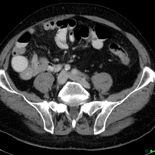 File:Acute appendicitis arising from a malrotated cecum (Radiopaedia 19970-19997 Axial C+ portal venous phase 28).jpg