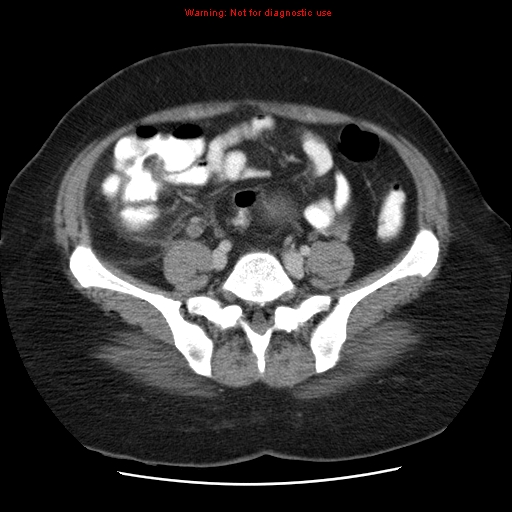 Acute appendicitis complicated by ovarian vein thrombophlebitis (Radiopaedia 16172-15851 Axial C+ portal venous phase 65).jpg