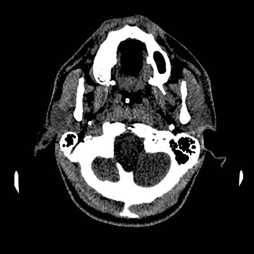 Acute basilar artery occlusion (Radiopaedia 43582-46985 Axial non-contrast 30).jpg