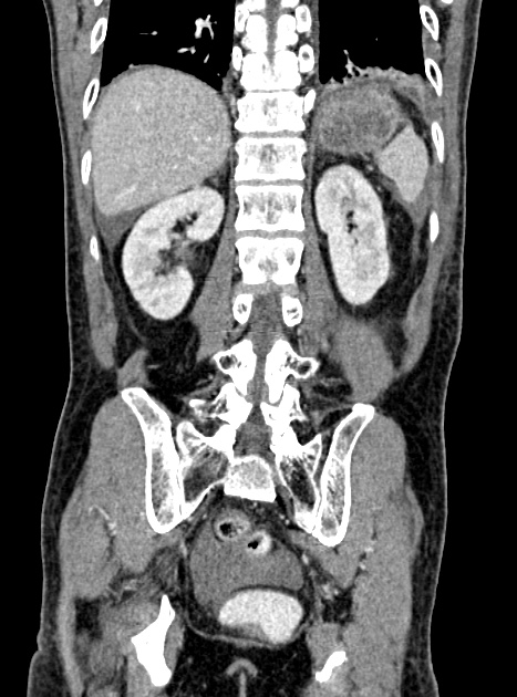 Acute bowel ischemia (Radiopaedia 87695-104114 Coronal C+ portal venous phase 282).jpg