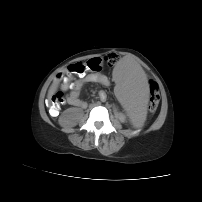 File:Acute calculous cholecystitis in patient with osteopetrosis (Radiopaedia 77871-90159 Axial non-contrast 50).jpg